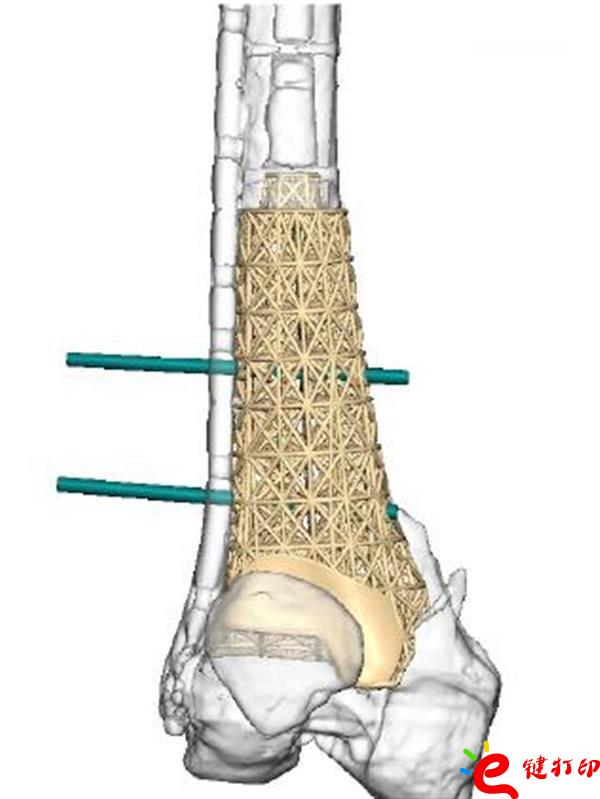 醫(yī)療3D打印,3d打印假肢,3d打印假肢,醫(yī)療3d打印模型,3D打印植入物,醫(yī)療3D打印平臺(tái)