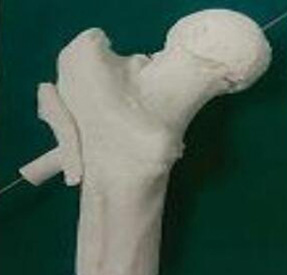 股骨金屬植入物3