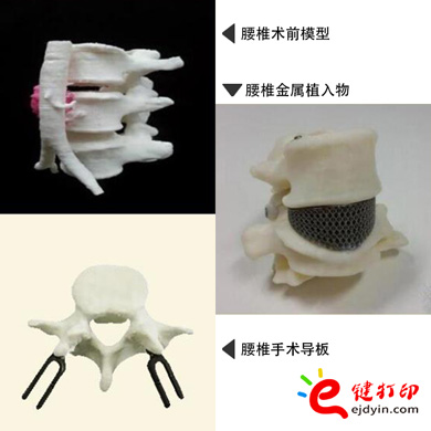 腰椎金屬植入物