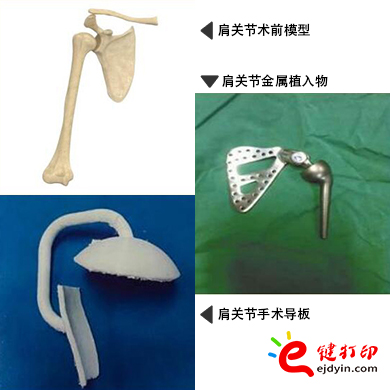 肩關節金屬植入物